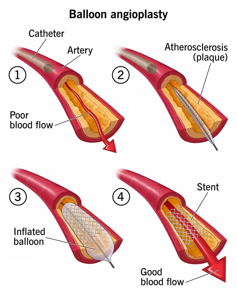 Interventional Radiology helping improve blood flow